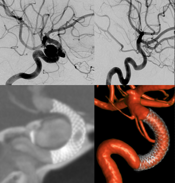 brain-aneurysm-neurointerventional-radiology